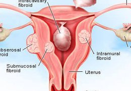 uterine fibroids specialist
