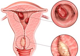 endometrial uterine polyps