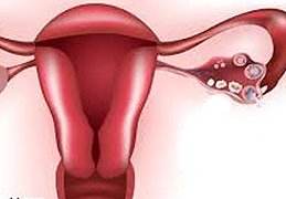 ovarian cysts removal doctor
