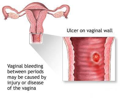 Abnormal Uterine Bleeding