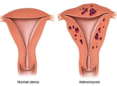 Adenomyosis