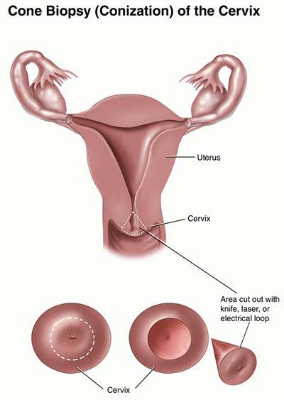 cervical cone biopsy