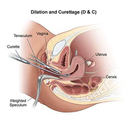 Dilation and Curettage (D&C)