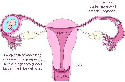 Ectopic Pregnancy