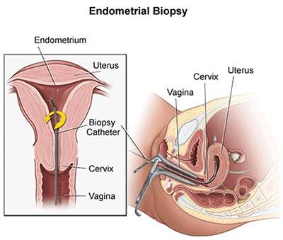 Endometrial Biopsy Procedure