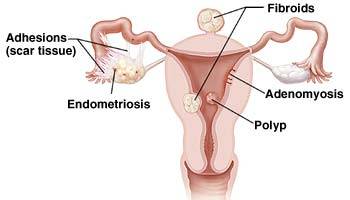 Endometrial Polyps