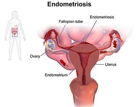 Endometriosis