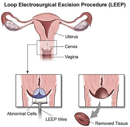 Loop Electrosurgical Excision Procedure (LEEP)