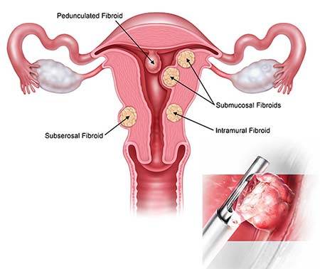 MyoSure Fibroid Polyp Removal
