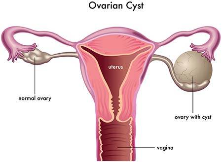 ovarian cysts