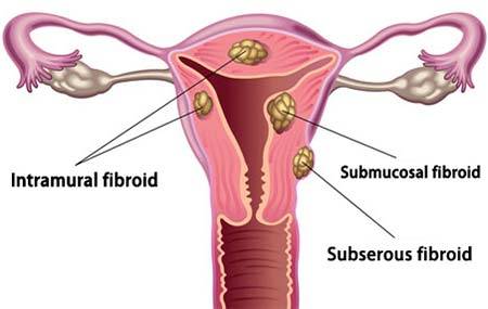Uterine Fibroids | Enlarged Uterus