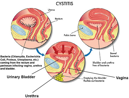 Cystitis | Bladder Infection | NYC Pelvic Doctor