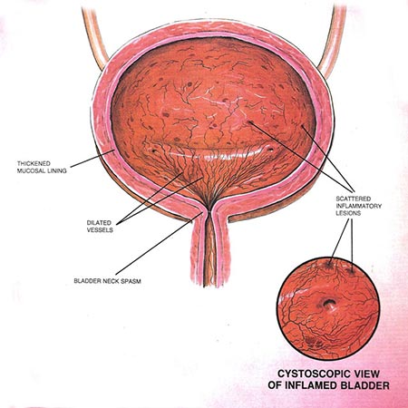 Interstitial Cystitis | NYC Pelvic Doctor