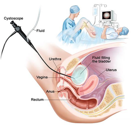 Cystoscopy Procedure Gynecologist NYC