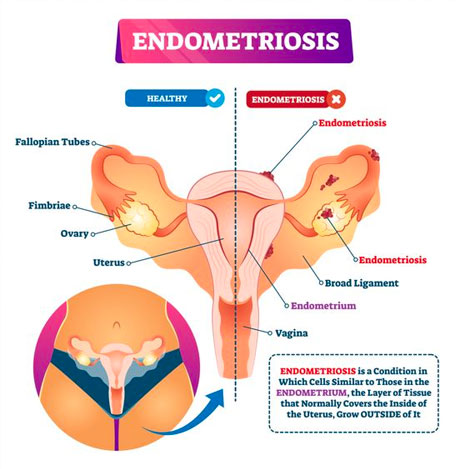 diagnosing endometriosis