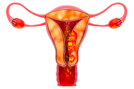 uterine cancer screening