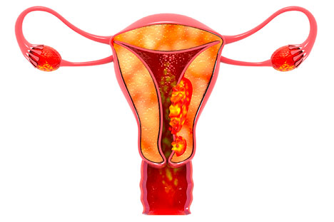 uterine cancer screening