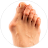 Bunions and Corns Treatment