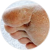 Athletes Foot Treatment