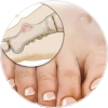 Ingrown Toenails Treatment