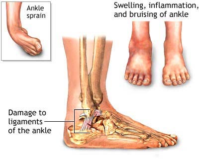 Ankle Sprain Specialist NYC