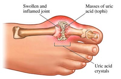 Arthritis In Feet Specialist NYC