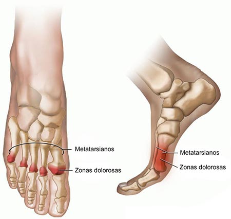 Ball of Foot Pain (Metatarsalgia)