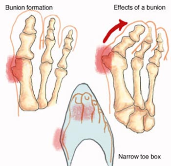 Bunions and Corns Specialist NYC