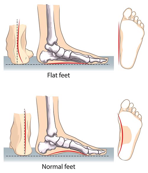 Flat Feet Correction Specialist NYC