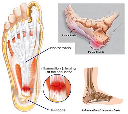 Heel Pain Treatment Specialist NYC