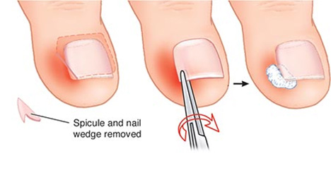 Ingrown Toenail Removal