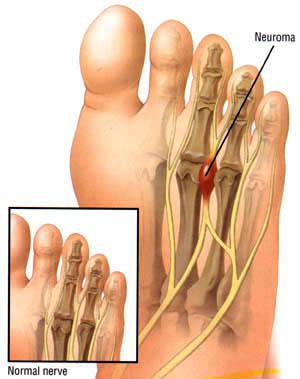 Neuroma Surgery NYC