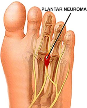 Neuromas (Nerve Tumors) Specialist NYC