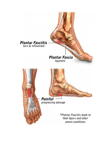 Plantar Fasciitis Specialist NYC