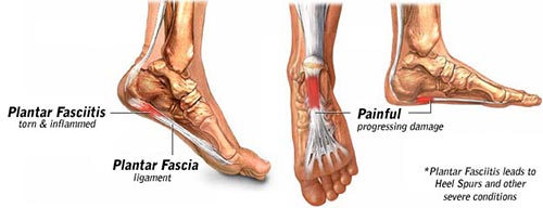 Plantar Fasciitis Surgery NYC