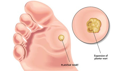 Plantar Warts Specialist NYC