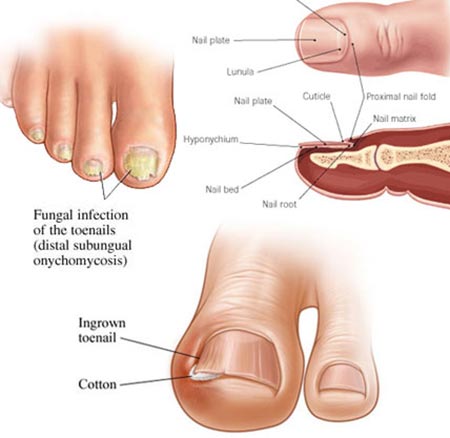 Toenail Fungus Treatment NYC