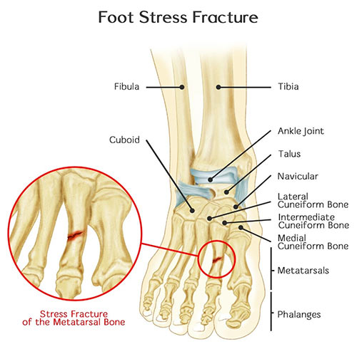 Foot Fracture Doctor NYC