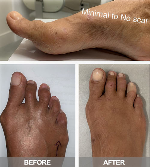 bunion surgery in nyc | before after