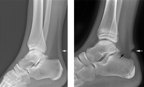 Achilles Tendon Rupture XRAY | Achilles Tendon Surgeon in NYC