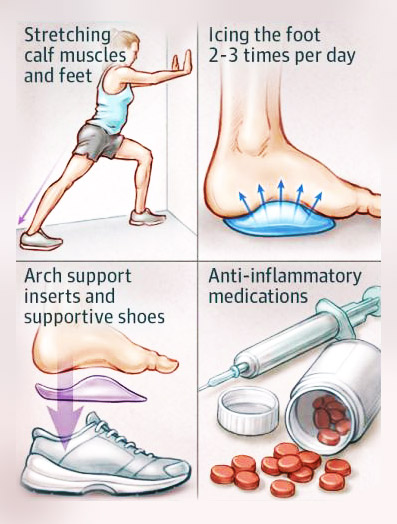 Alternative Treatment for Plantar Fasciitis