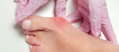 bunion Surgery