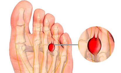 Neuromas Nerve Tumors