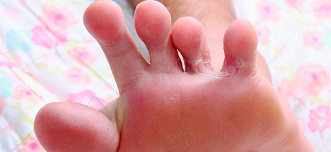 Athlete foot condition and treatment