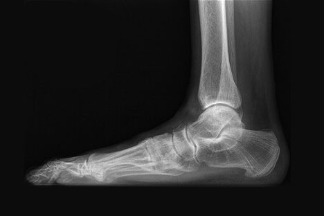 flat foot surgery