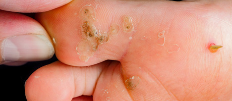 foot warts treatment