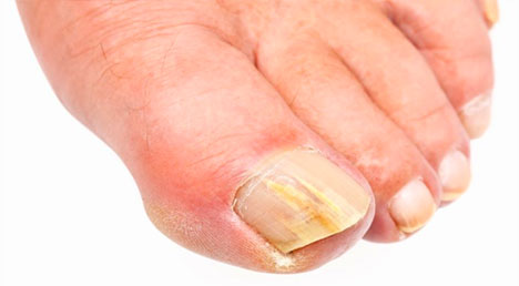 fungal nails condition