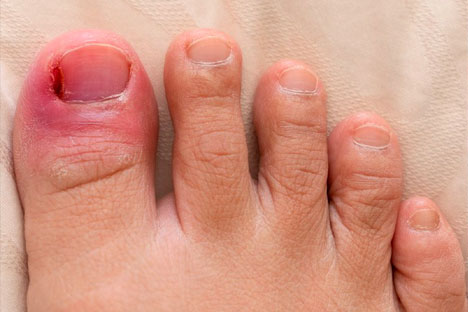 ingrown toenail