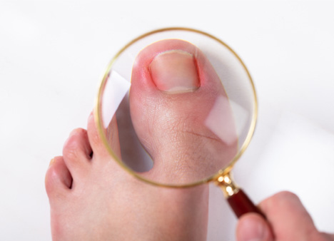 ingrown toe nails swelling