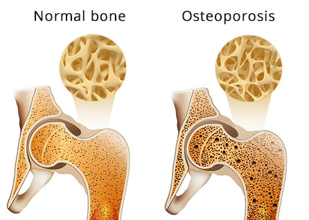 Osteoporosis Treatment Manhattan NYC